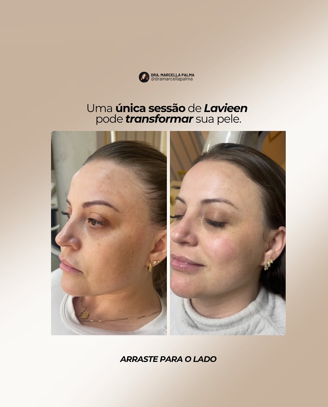 Antes e depois de tratamento Laser Lavieen – rejuvenescimento da pele em Lages, SC