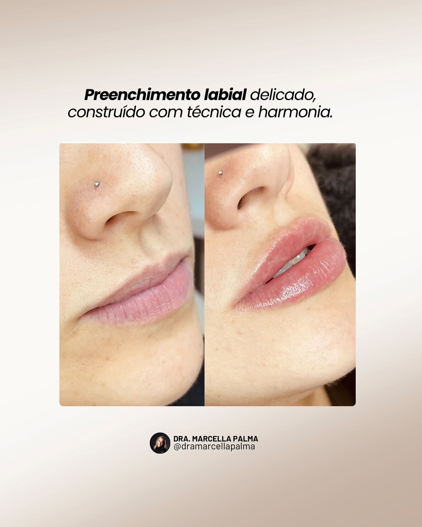 Harmonização Labial – tratamento estético dos lábios em Lages, SC